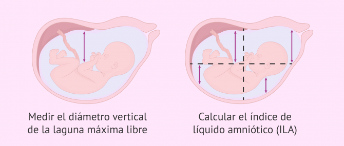 Imagen: Poco o mucho líquido amniótico