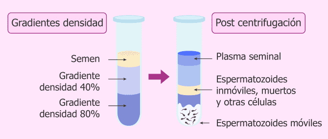 Imagen: Capacitación espermática por gradientes de densidad