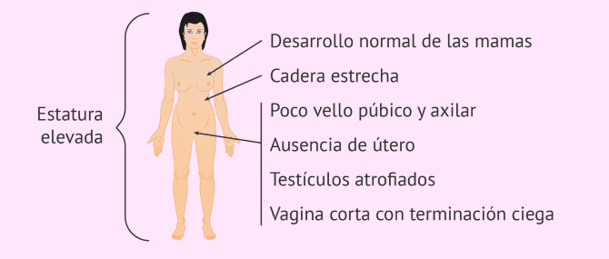 Imagen: Características del síndrome de Morris