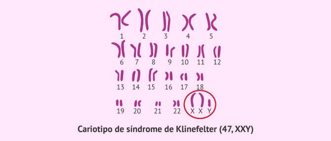 Imagen: Cariotipo del síndrome de Klinefelter