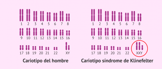 Imagen: Cariotipo normal y cariotipo con síndrome de Klinefelter