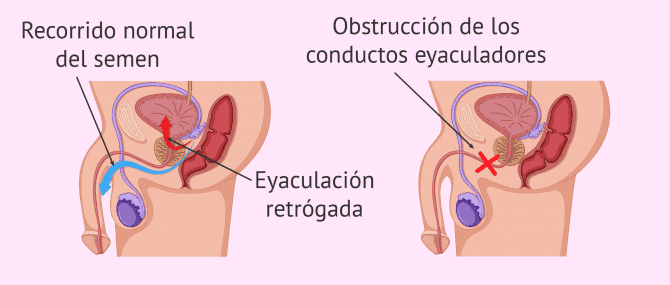 Imagen: Eyaculación retrógrada y obstrucción de los conductos