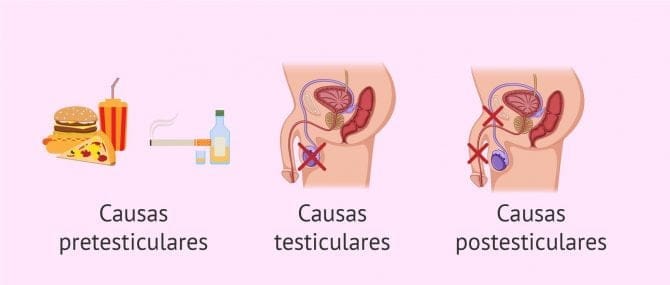 Imagen: Causas de la criptozoospermia