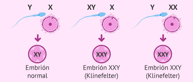 Imagen: Causas genéticas del síndrome de Klinefelter