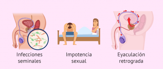 Imagen: Causas de infertilidad por factor postesticular