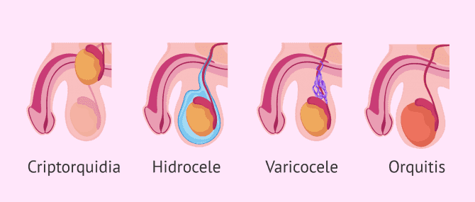 Imagen: Causas testiculares de oligospermia