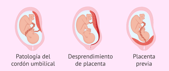 Imagen: Causas placentarias de muerte fetal