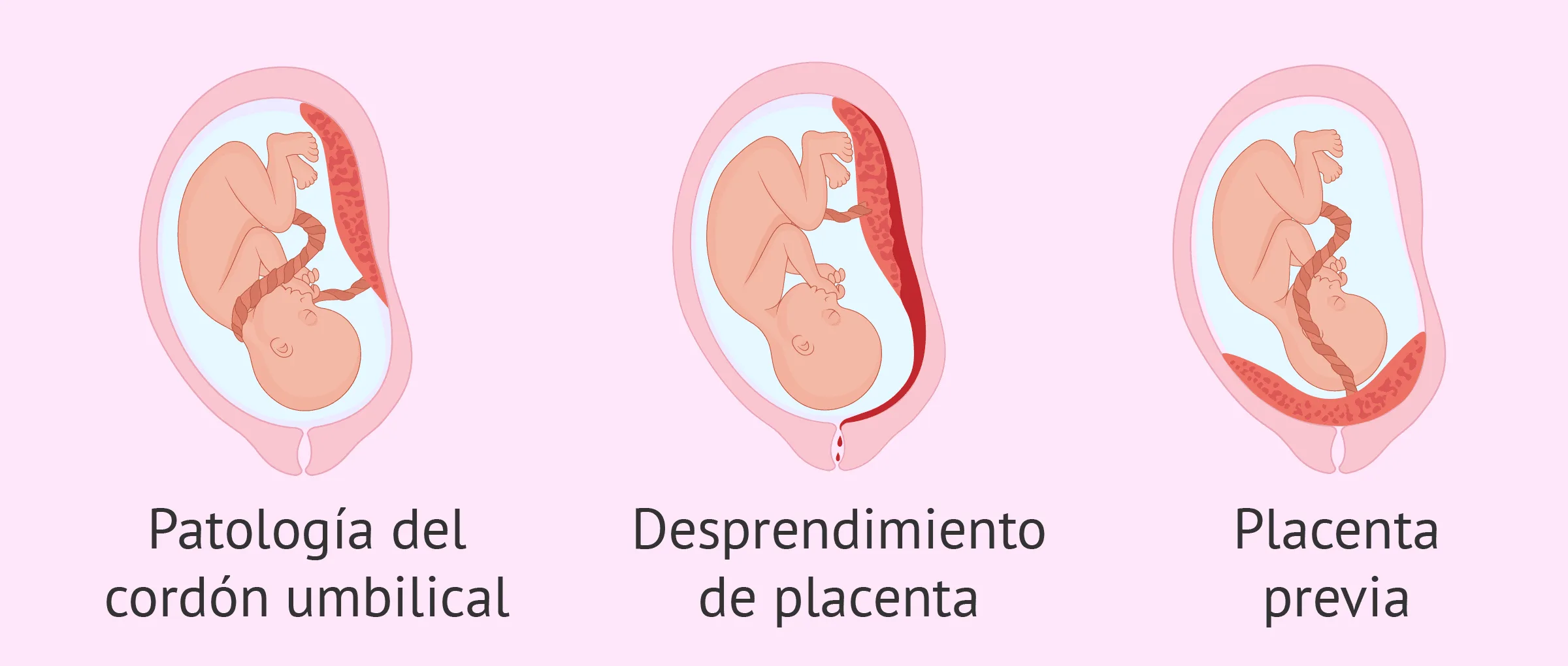 Causas placentarias de muerte fetal