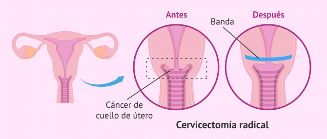 Imagen: Cervicectomía radical