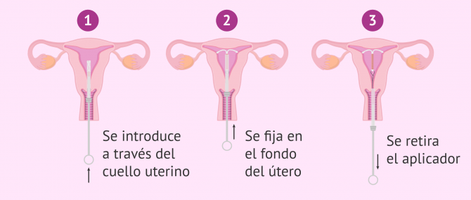 Imagen: Funcionamiento del DIU