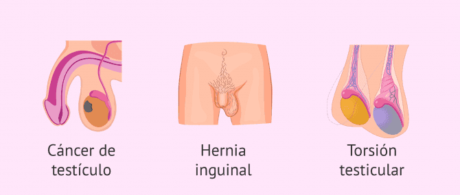 Imagen: Hernia inguinal, torsión testicular y cáncer testicular