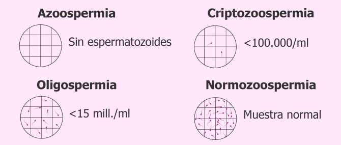 Imagen: Espermograma con azoospermia, criptozoospermia, oligospermia y normozoospermia