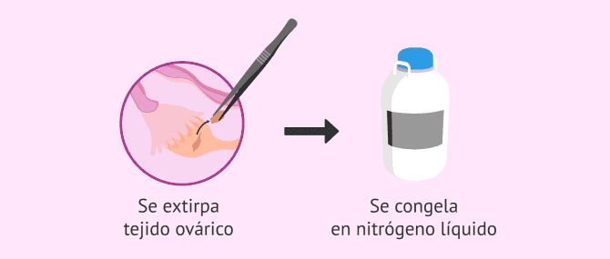 Imagen: Congelar tejido ovárico y testicular