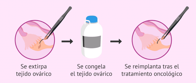 Imagen: Congelación de tejido ovárico