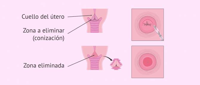 Imagen: Operación cuello del útero