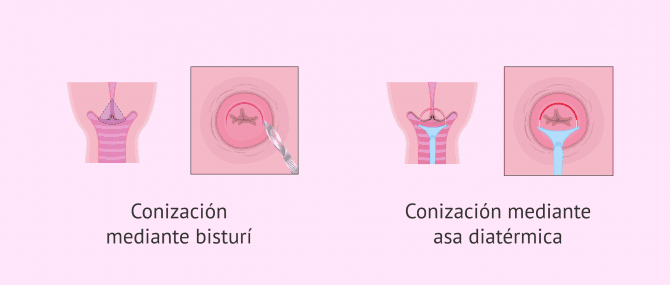 Imagen: Tipos de conización