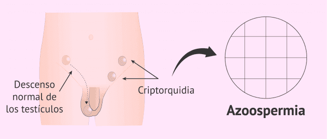 Imagen: Criptorquidia y azoospermia