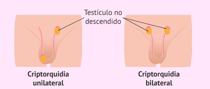 Imagen: Criptorquidia y fertilidad