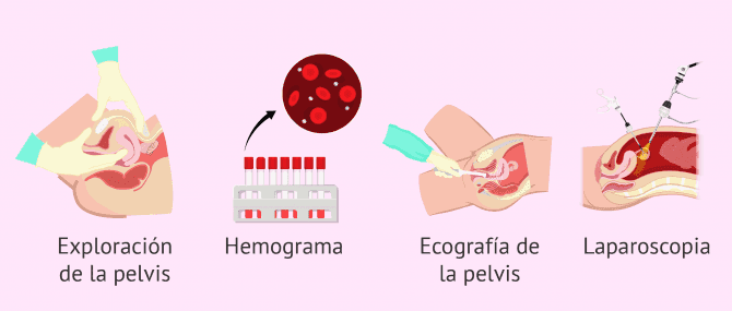 Imagen: Diagnóstico de la enfermedad inflamatoria pélvica