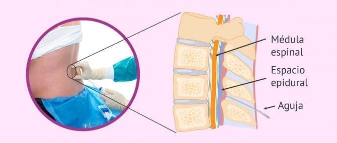 Imagen: ¿Dónde se pone la anestesia epidural?