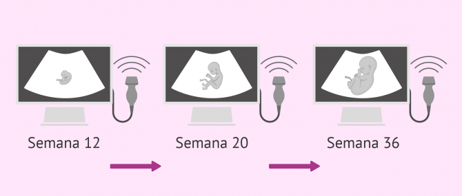 Imagen: Ecografías fetales