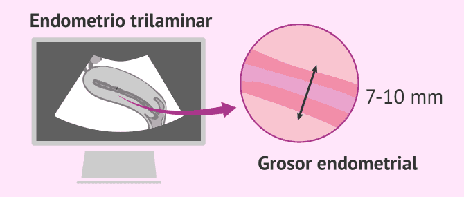 Imagen: Ecografía para ver el endometrio