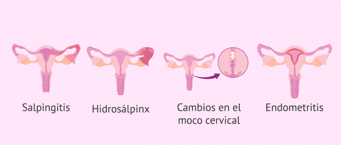 Imagen: Manifestaciones de las ETS en la fertilidad femenina