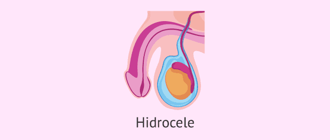 Imagen: El hidrocele