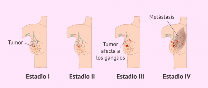 Imagen: Estadios del cáncer de mama