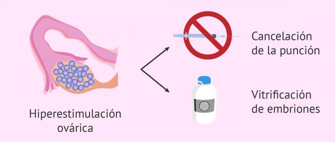 Imagen: Hiperestimulación del ovario por estimulación ovárica