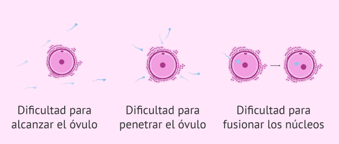 Imagen: Teratozoospermia y fallos de fecundación