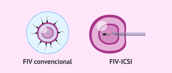 Imagen: FIV convencional - ICSI