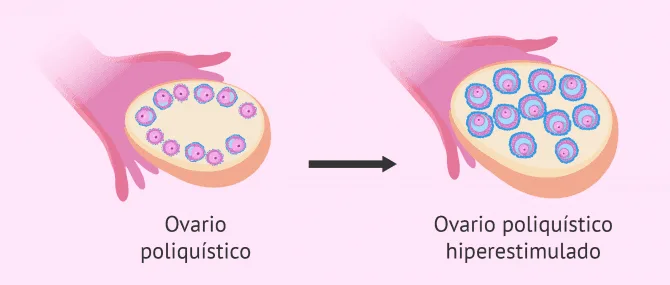 Fertilidad con el sindrome de ovarios poliquisticos SOP