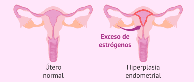 Imagen: La hiperplasia endometrial