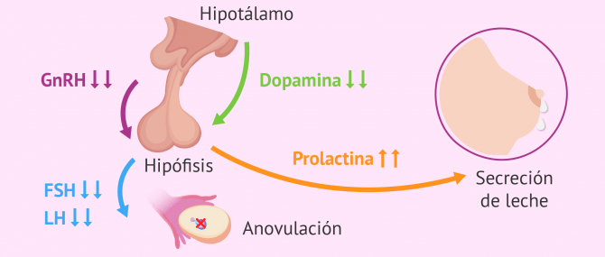 Imagen: ¿En qué consiste la hiperprolactinemia?