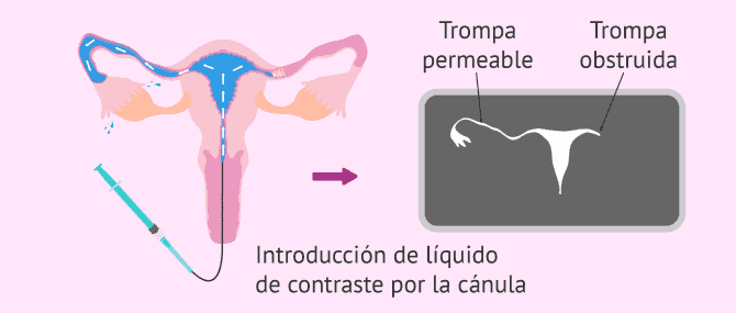 Imagen: Pruebas diagnósticas para el análisis de las trompas de Falopio