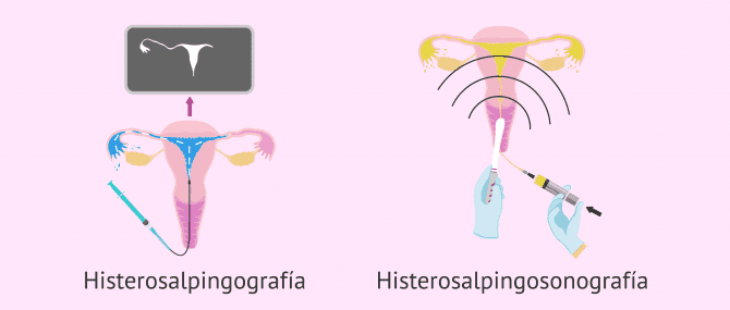 Imagen: Tipos de histerosalpingografía