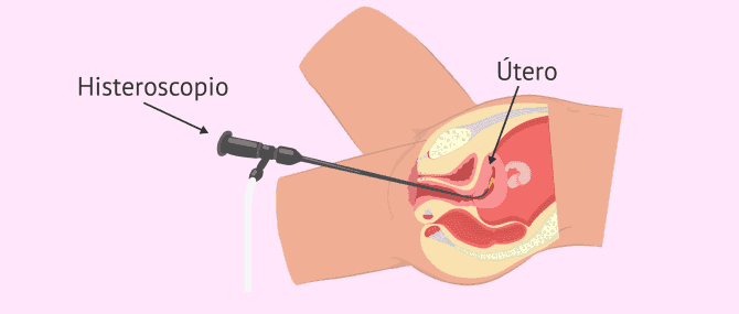 Imagen: ¿Cómo se hace una histeroscopia?