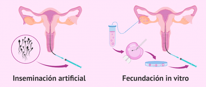 Imagen: Reproducción asistida para mujeres con SOP