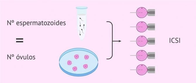 Imagen: ICSI en varones con criptozoospermia