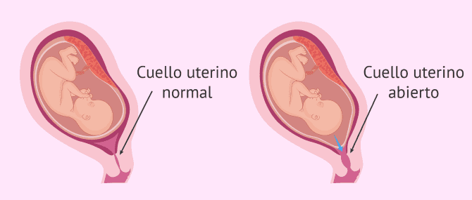 Imagen: Incompetencia cervical