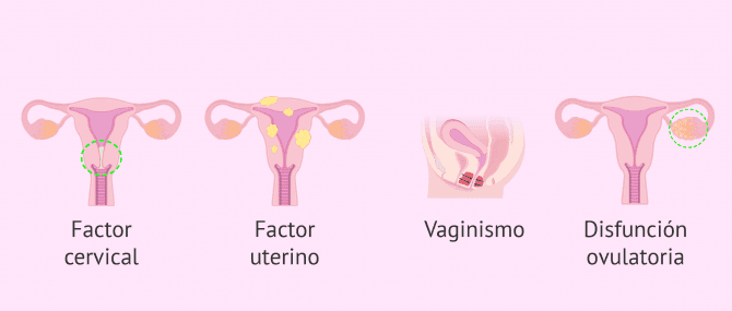 Imagen: Indicaciones de la IAC por esterilidad femenina