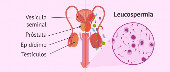 Imagen: Causas de la piospermia