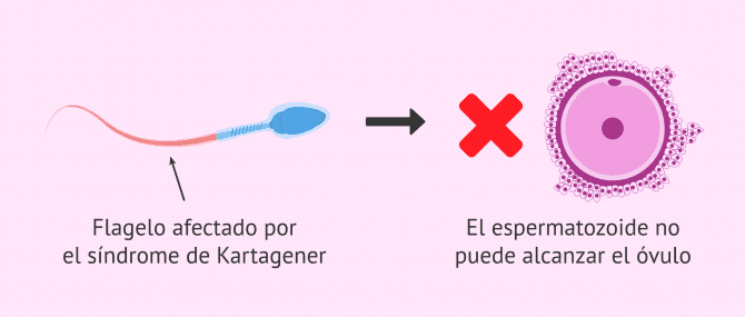 Imagen: Infertilidad masculina por el síndrome de Kartagener