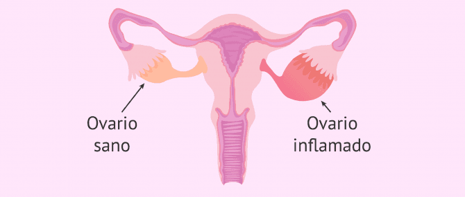 Imagen: Inflamación del ovario (ooforitis)