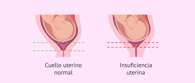 Imagen: Insuficiencia uterina