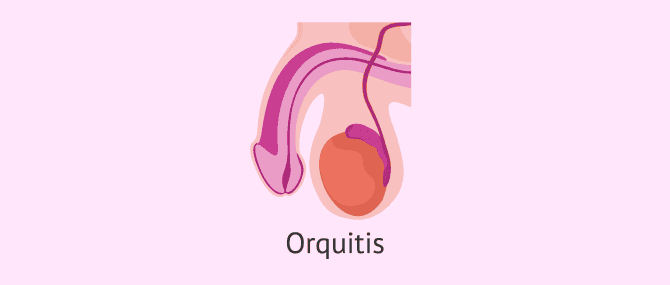 Imagen: La orquitis testicular