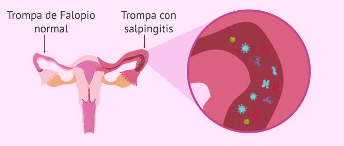 Imagen: Salpingitis unilateral