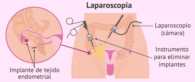 Imagen: Laparoscopia para diagnosticar endometriosis