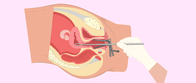 Imagen: Tratamiento del aborto